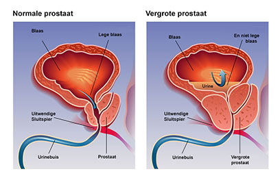 Advies voor het behoud van een gezonde prostaat
